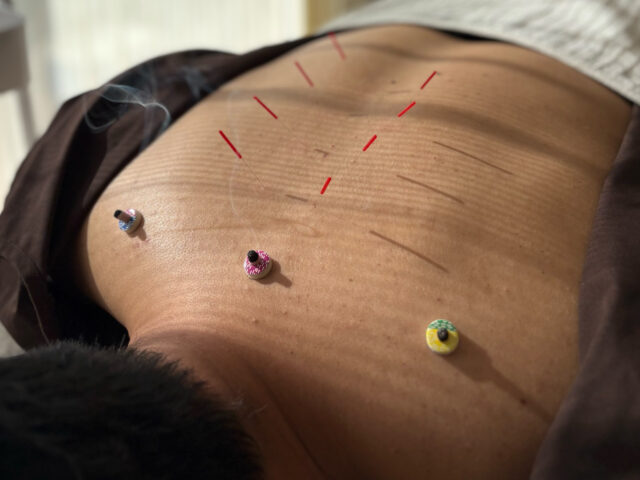 鍼治療について